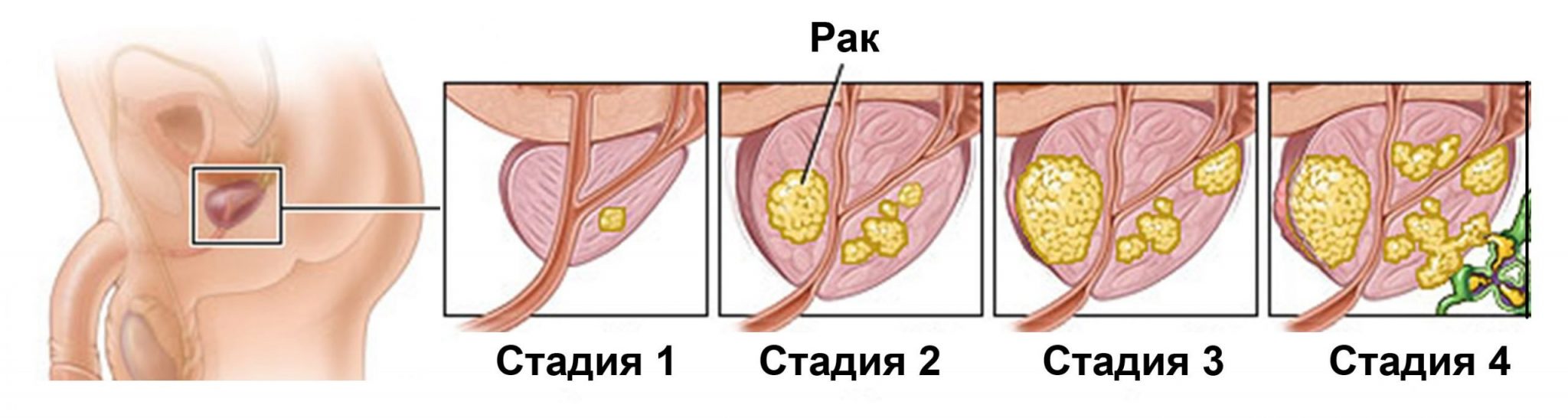 Рак простаты: что это такое и как его обнаружить