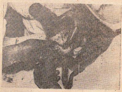 Рис. 1. Момент извлечения плода при кесаревом сечении тракцией за голову. Применение этого пособия может травмировать плод