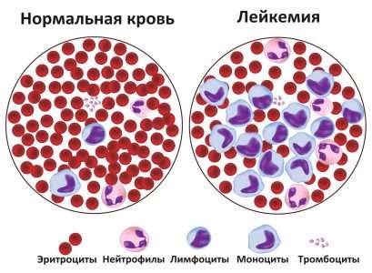 Лейкемия. Интересный случай
