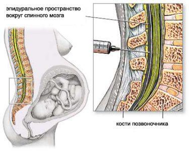 Эпидуральная (перидуральная) анестезия