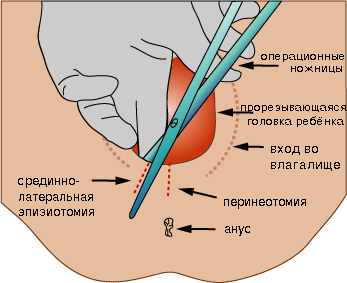 Эпизиотомия