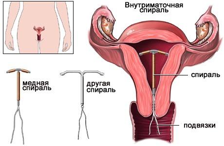 Внутриматочные средства