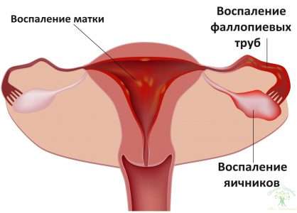 Послеродовой эндометрит