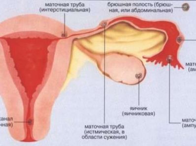 Внематочная беременность в следственной и судебно-медицинской практике