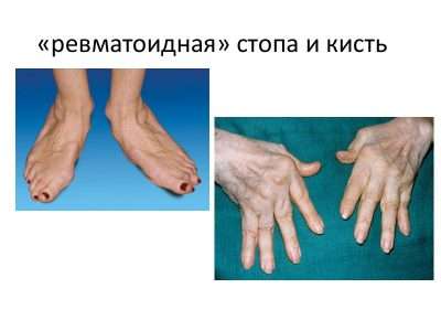 Пшеница, Глютен И Ревматоидный Артрит