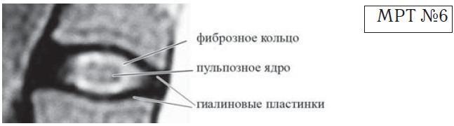 На данном снимке хорошо просматривается пульпозное ядро, гиалиновые пластинки и фиброзное кольцо На данном снимке хорошо просматривается пульпозное ядро, гиалиновые пластинки и фиброзное кольцо