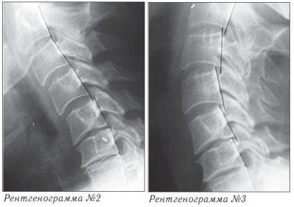 Остеохондроз позвоночника 10 Остеохондроз. Рентгенограмма