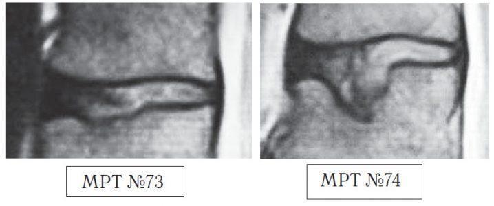 На МРТ №73 — увеличенный фрагмент МРТ №71 на уровне сегмента L1—L2, на котором наблюдается травма замыкательной пластинки L2 позвонка, как следствие первых двух сеансов у этого «специалиста». На МРТ №74 наблюдается увеличенный фрагмент МРТ №72 на уровне сегмента L1—L2, на котором наглядно видны последствия третьего сеанса «вправления диска», и как следствие — компрессионный «пролом» тела позвонка L2 и его замыкательной (гиалиновой) пластинки и внутренний разрыв межпозвонкового диска.