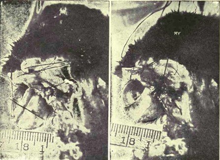 Рисунок 9. Демонстрация, на глазном яблоке кролика, того, что косые мышцы удлиняют зрительную ось при миопии.
R, состояние покоя. Глазное яблоко имеет нормальную длину и находится в состоянии эмметропии – то есть, полностью настроено на дальнее зрение.
Му, миопия. Натяжение косых мышц было усилено путём её перемещения, и ретиноскоп показал, что возникла миопия. Легко заметить, что глазное яблоко стало длиннее. Было невозможно избежать какого-либо движения головы между съёмкой этих двух кадров для демонстрации результата манипуляции с нитями. Но линейка показывает, что фокус камеры не был сильно изменён такими перемещениями.