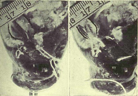 Рисунок 10. Демонстрация, на примере глаза карпа, того, что прямые мышцы укорачивают зрительную ось при гиперметропии.
R, состояние покоя. Глазное яблоко имеет нормальную длину и находится в состоянии эмметропии. Ну, гиперметропия. Натяжение внешней и внутренней прямой мышц было усилено путём перемещения и ретиноскоп показывает, что возникла гиперметропия. Ещё легче заметить, что глазное яблоко стало короче. Линейка показывает, что фокус камеры не был существенно изменён между этими двумя фотографиями.