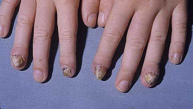 Кандидоз. Этиология, клиника, диагноз и лечение 29 13Kandidoz Granuloma9653 Gp3 A Foto