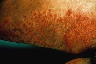 Как избавиться от молочницы? 5 400px derm 57 1