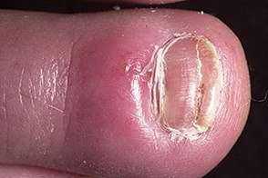 Кандидоз. Этиология, клиника, диагноз и лечение 25 Acute Paronychia 13 Foto