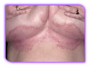 Кандидоз. Этиология, клиника, диагноз и лечение 23 Kandidoz Large Skin Folds 54 A Foto